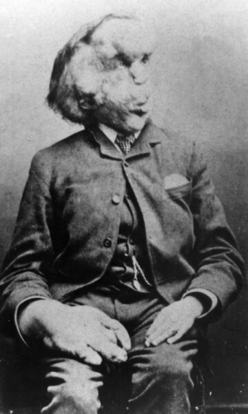 Joseph Carey Merrick